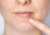 Kada herpes prestaje biti zarazan? Evo što trebate znati
