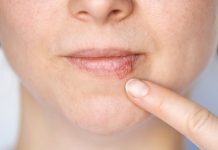Kada herpes prestaje biti zarazan? Evo što trebate znati