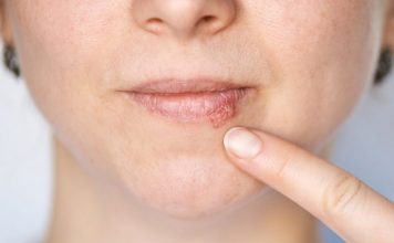 Kada herpes prestaje biti zarazan? Evo što trebate znati