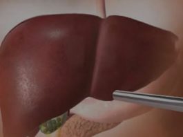 OVA HRANA UNIŠTAVA JETRU SKORO ISTO KOLIKO I ALKOHOL: 5 namirnica čiji unos morate ograničiti