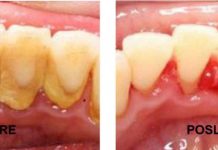 Držite ovu smjesu u ustima 60 sekundi i uklonit ćete vecinu kamenca sa zuba!