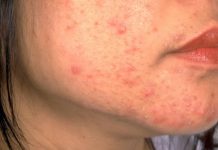 OPREZ! RODITELJI, OBRATITE PAŽNJU NA OVO! Ove navike mogu spasiti kožu vaše djece od akni, VAŽNO JE DA POČNETE ODMAH