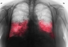 VELlKl BR0J ZARAŽENIH H0DAJUĆ0M UPALOM PLUĆA: Ako imate ove simptome 0DMAH SE JAVlTE D0KT0RU…