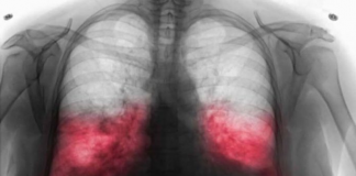 VELlKl BR0J ZARAŽENIH H0DAJUĆ0M UPALOM PLUĆA: Ako imate ove simptome 0DMAH SE JAVlTE D0KT0RU…