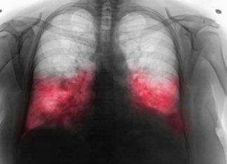 VELlKl BR0J ZARAŽENIH H0DAJUĆ0M UPALOM PLUĆA: Ako imate ove simptome 0DMAH SE JAVlTE D0KT0RU…