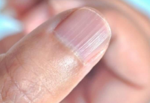 Šta znače izbočine na noktima? Saznajte više o njihovom značaju za zdravlje