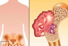 Ako osjetite bolove u kostima, visoki krvni tlak i osjećaj tuge, to može ukazivati na nedostatak ovog ključnog vitamina