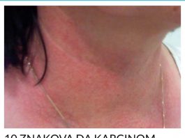 10 ZNAKOVA DA KARCINOM RASTE U VAŠEM TIJELU: Ovo su rani znakovi raka!